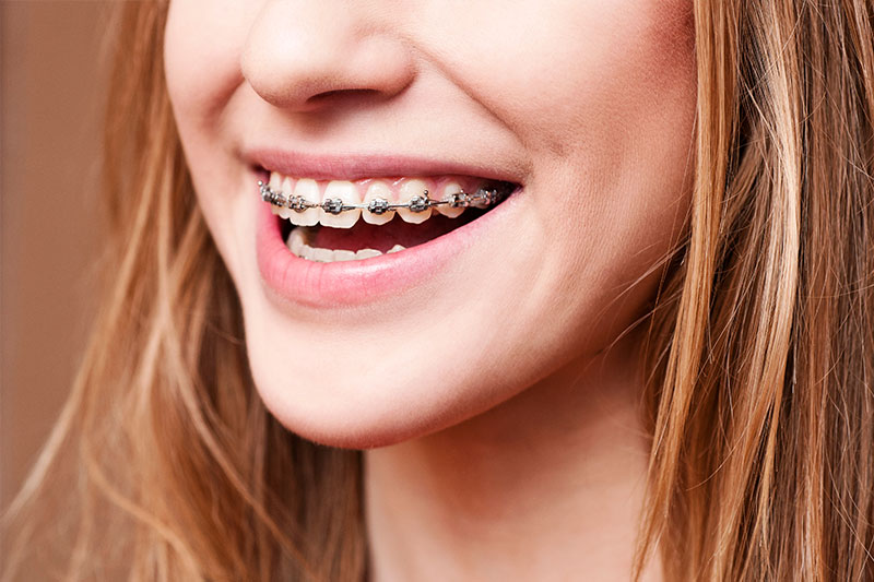 Orthodontics in Saint Cloud