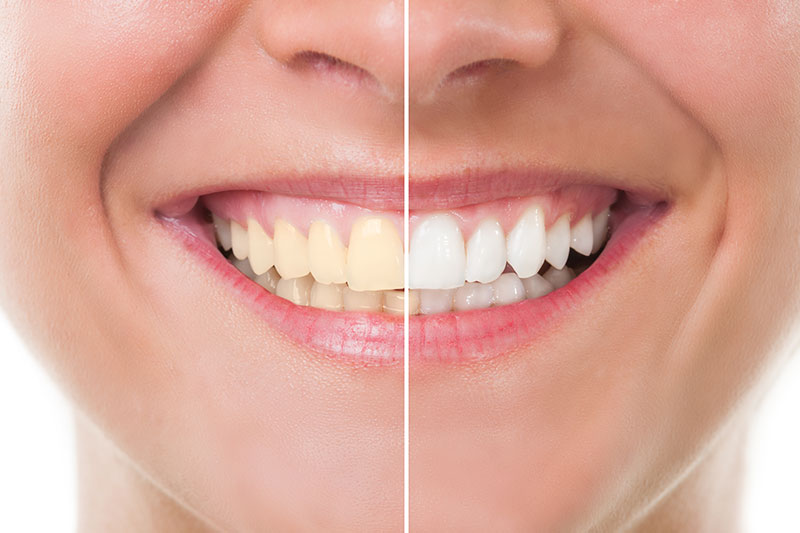 Teeth Whitening in Saint Cloud